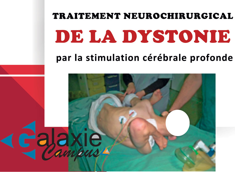 Traitement Neurochirurgical de la DYSTONIE par la Stimulation Cérébrale Profonde