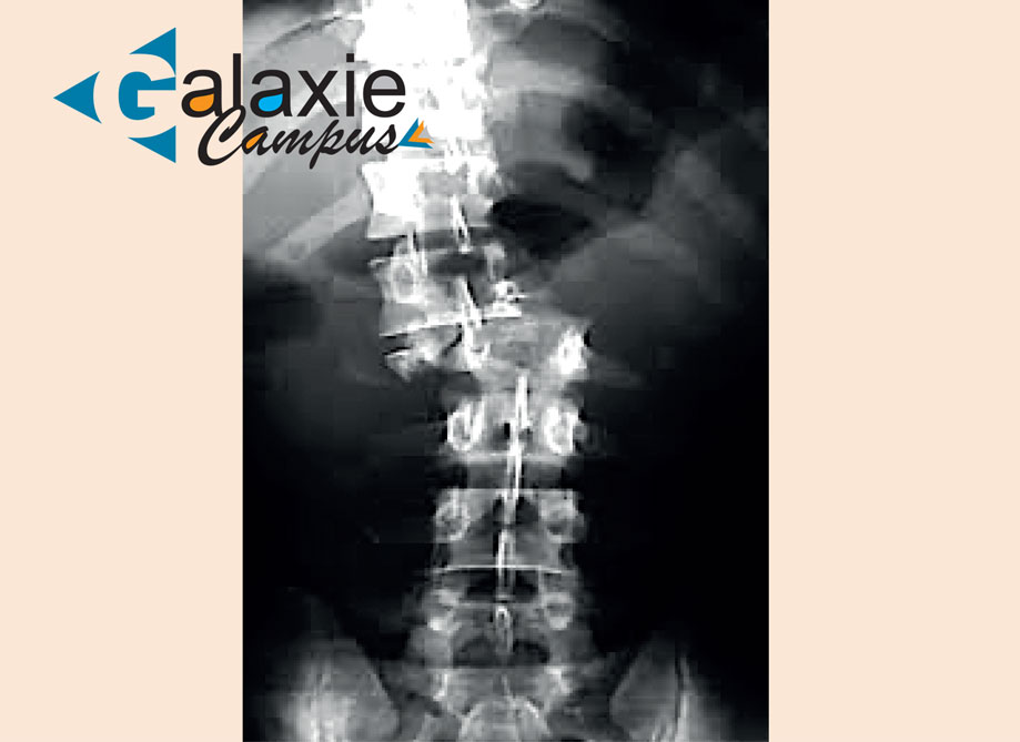 Traumatisme Vertébromédullaire