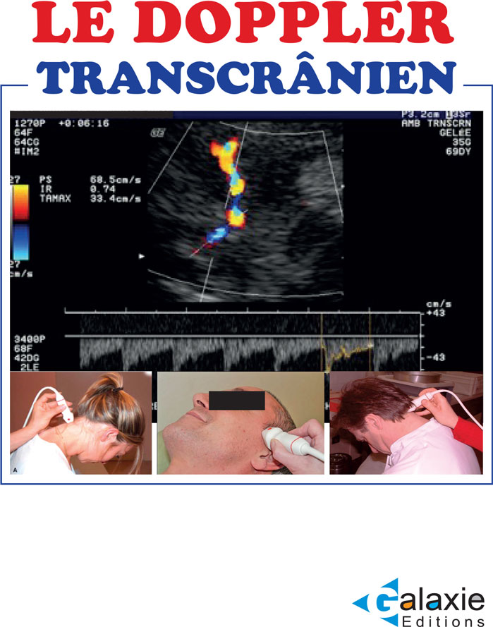 Le Doppler Transcrânier