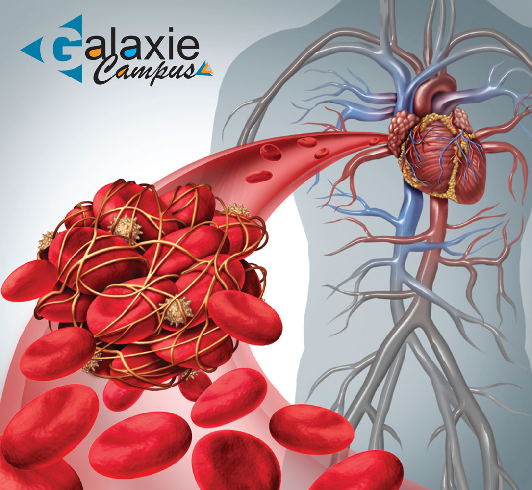 La Maladie THROMOEMBOLIQUE VEINEUSE