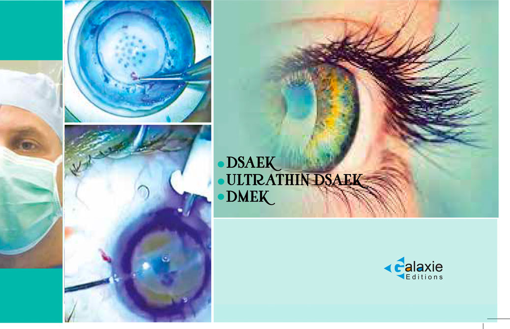 Kératoplastie Lamellaire Postérieure