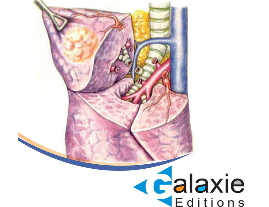 Actualités dans la prise en charge chirurgicale des Cancers Bronchiques non à petites cellules