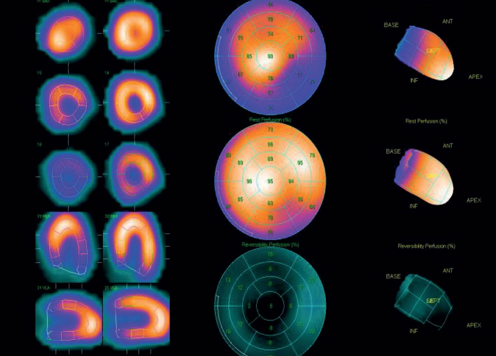 Tomoscintigraphie Myocardique Guide Pratique