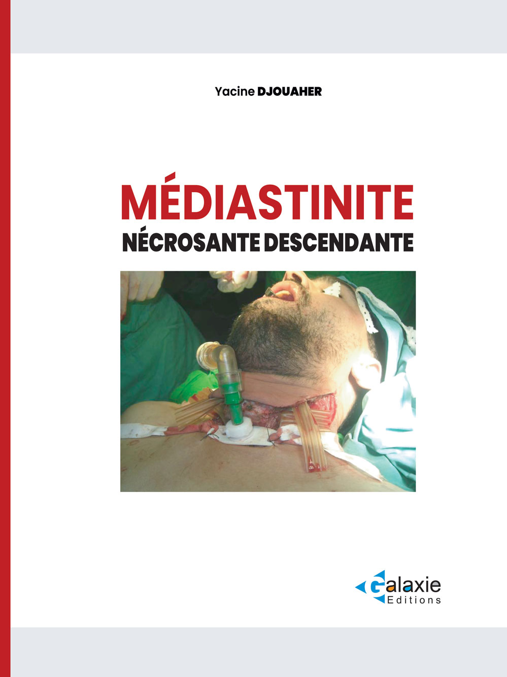 Médiastinite Nécrosante Descendante