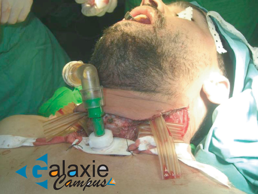 Médiastinite Nécrosante Descendante