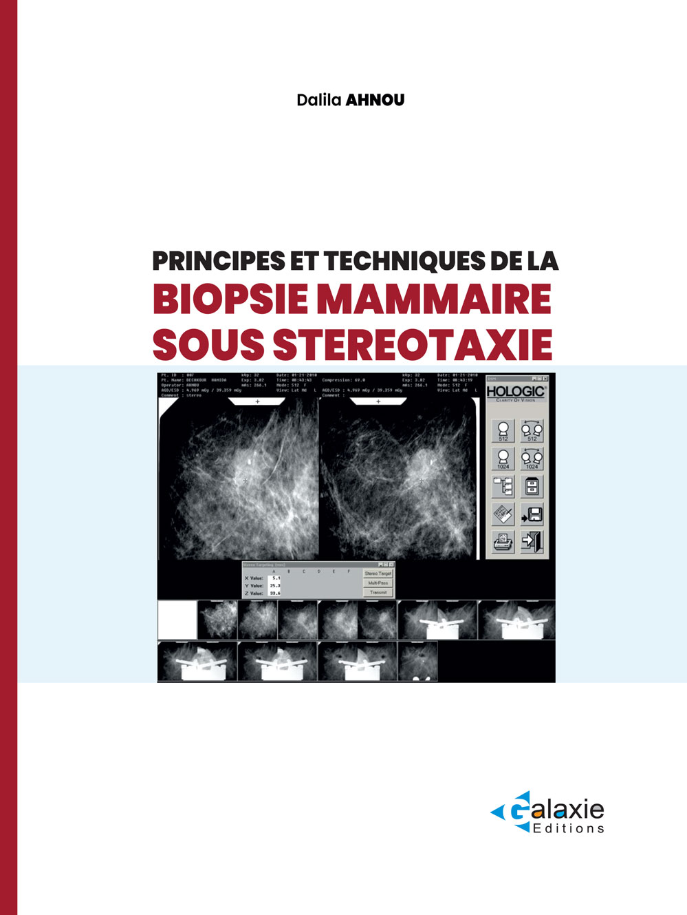 Principes et Techniques de la BIOPSIE MAMMAIRE SOUS STÉRÉOTAXIE