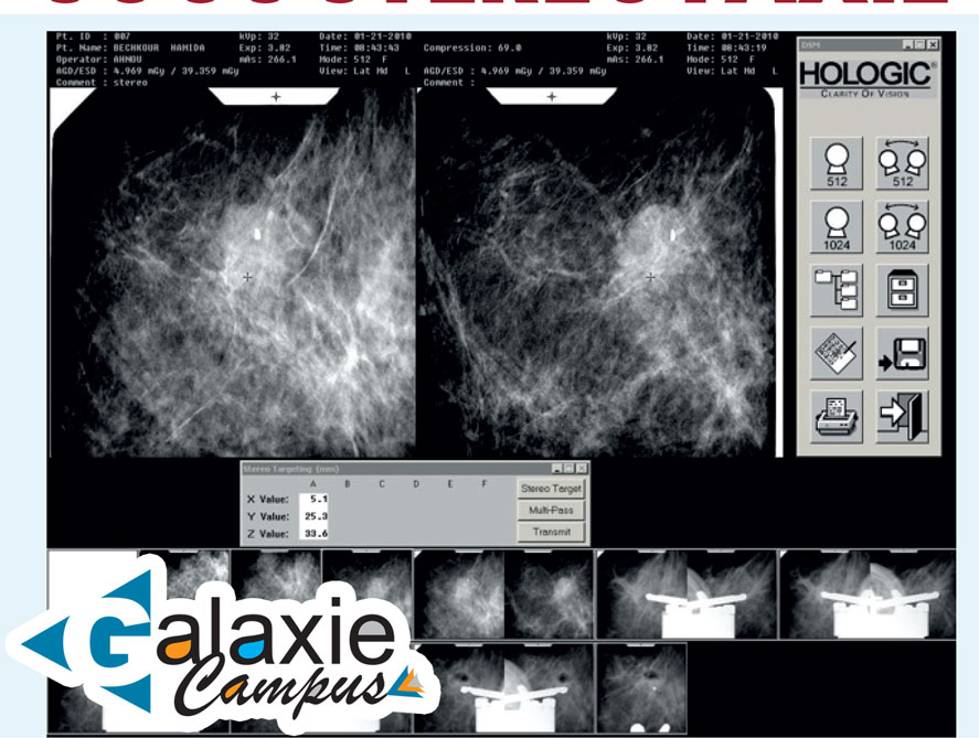 Principes et Techniques de la BIOPSIE MAMMAIRE SOUS STÉRÉOTAXIE