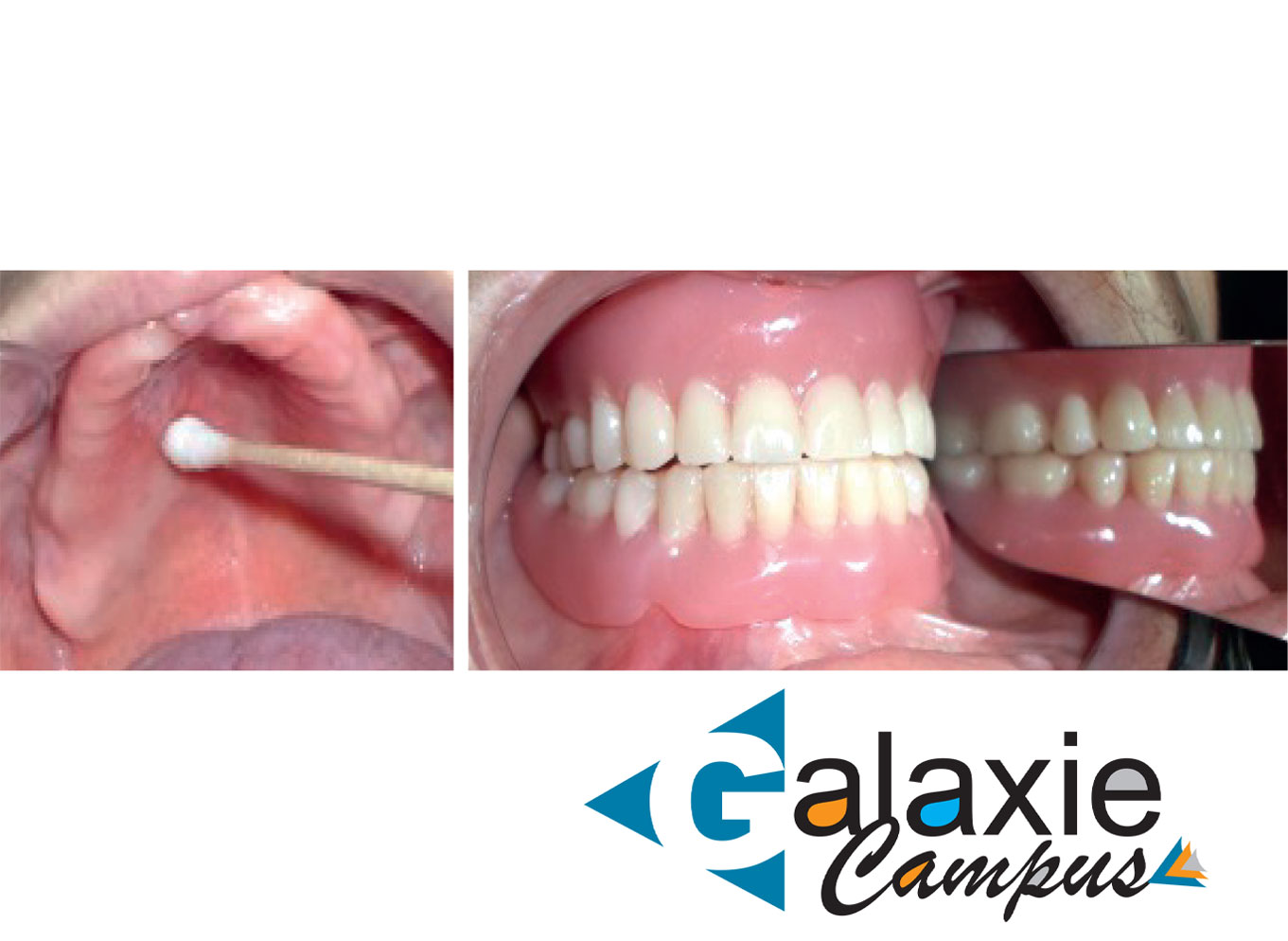 Le Milieu Buccal chez l'ÉDENTÉ TOTAL SAIN ET DIABÉTIQUE DE TYPE 2