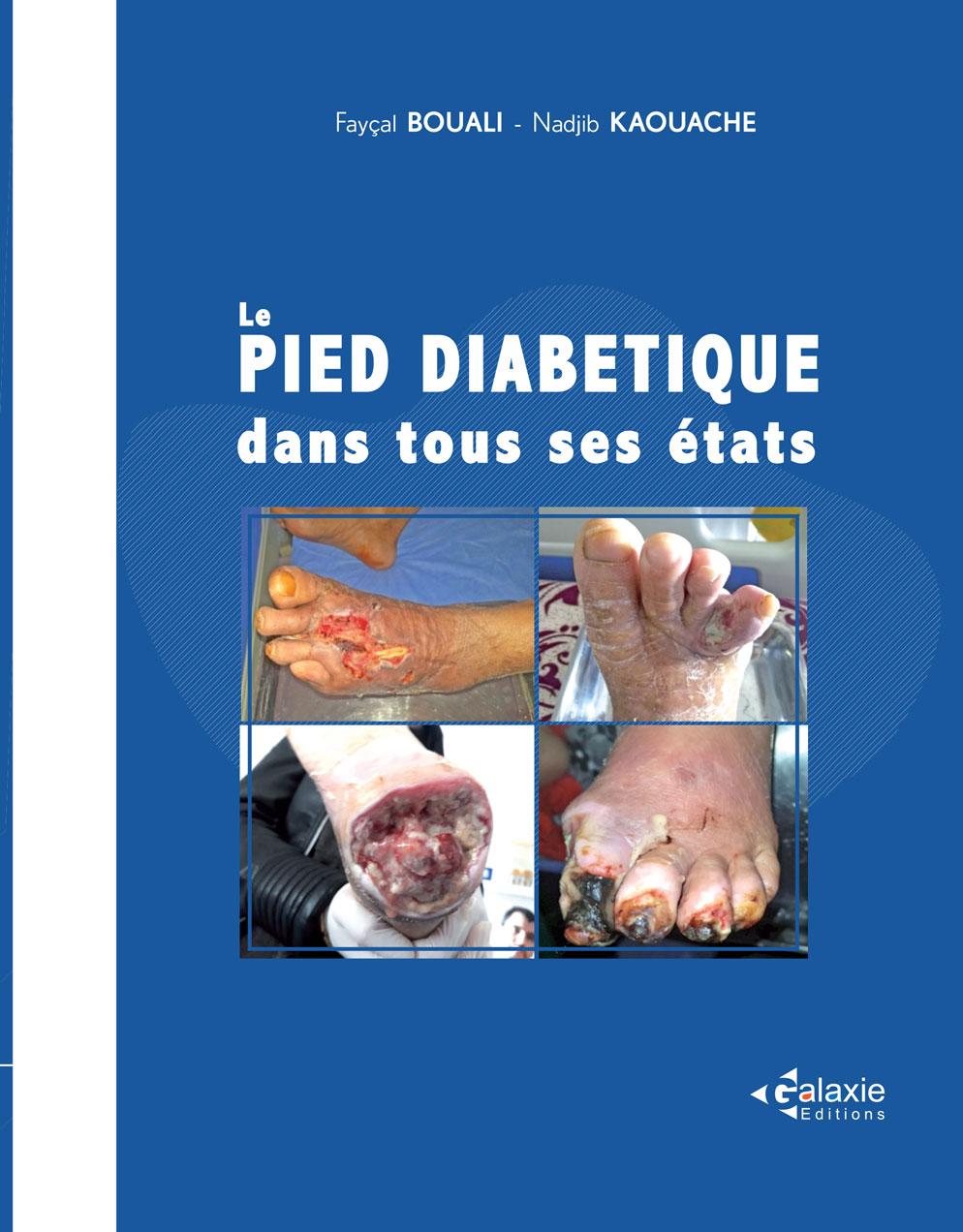Le PIED DIABÉTIQUE dans tous ses états