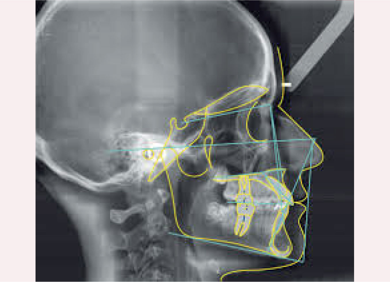 Evolution de l'analyse céphalométrique sur les TÉLÉRADIOGRAPHIES DE PROFIL
