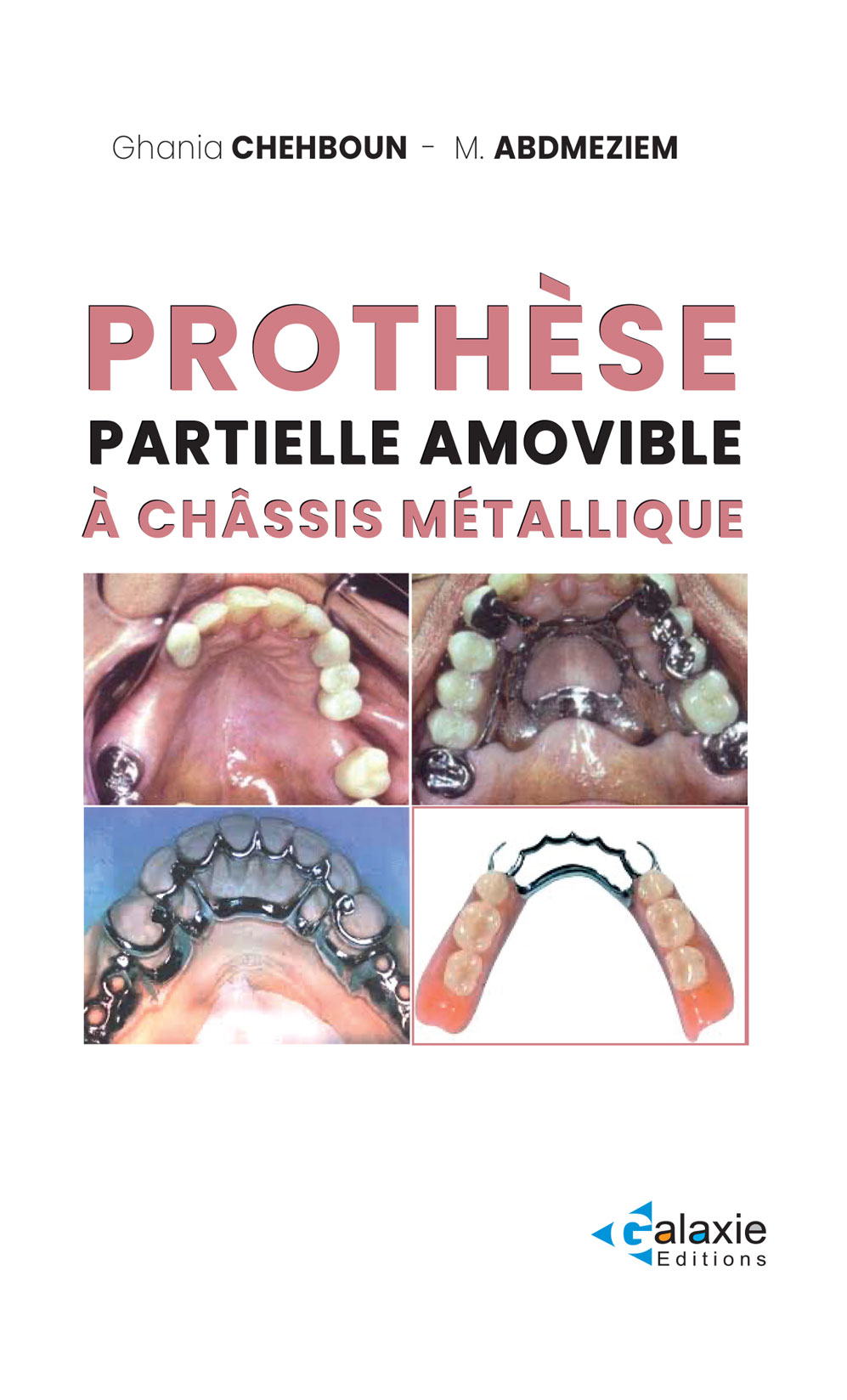 Prothèse Partielle Amovible à Châssis Métallique