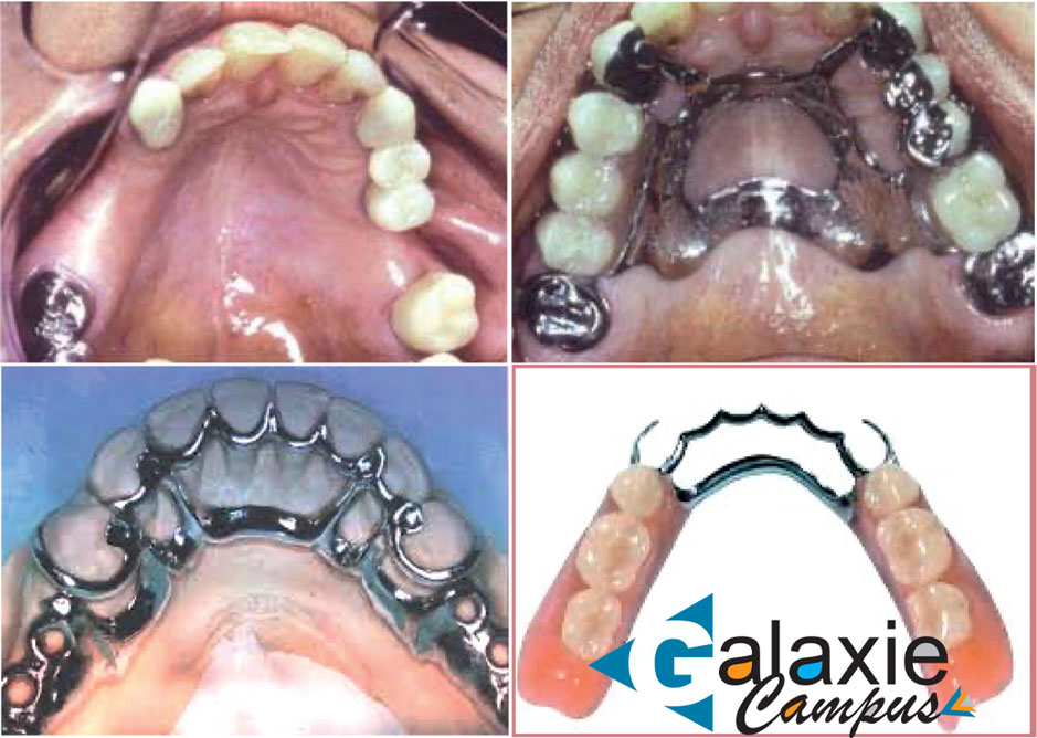 Prothèse Partielle Amovible à Châssis Métallique