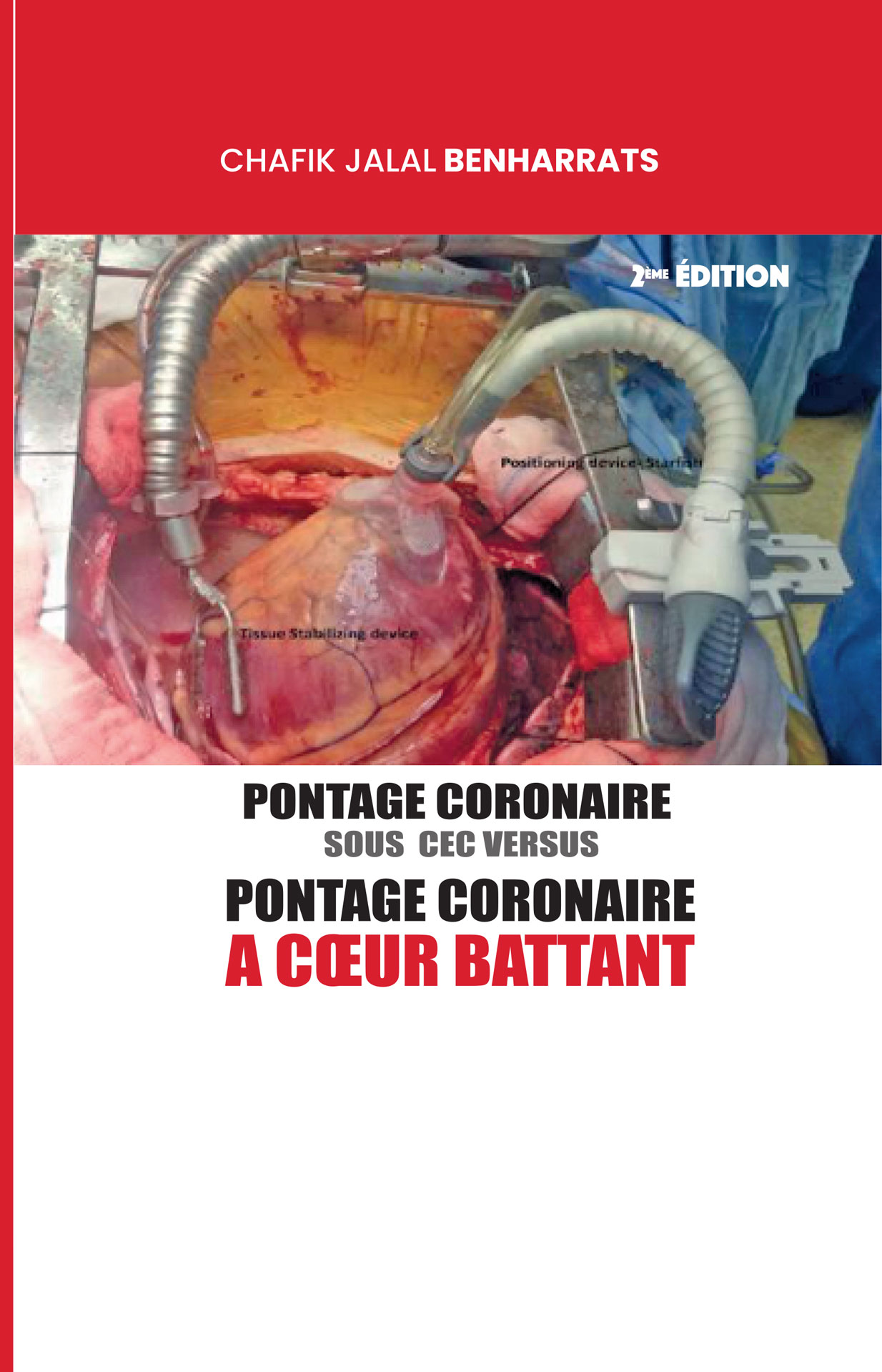 Pontage Coronaire sous  CEC VERSUS , Pontage Coronaire à Coeur Battant