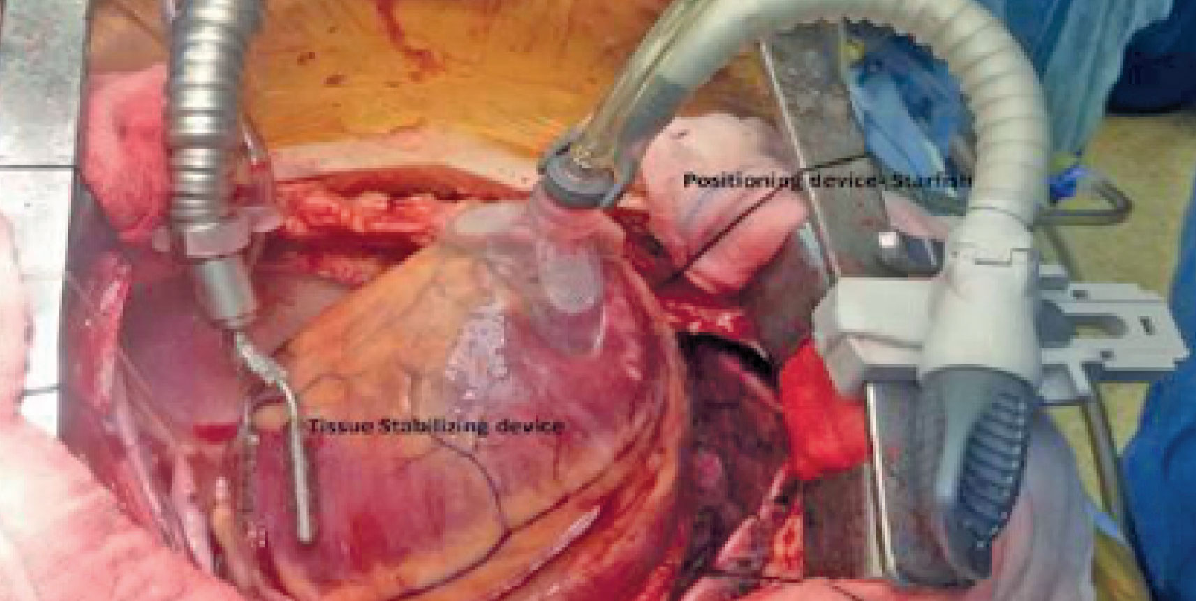 Pontage Coronaire sous  CEC VERSUS , Pontage Coronaire à Coeur Battant