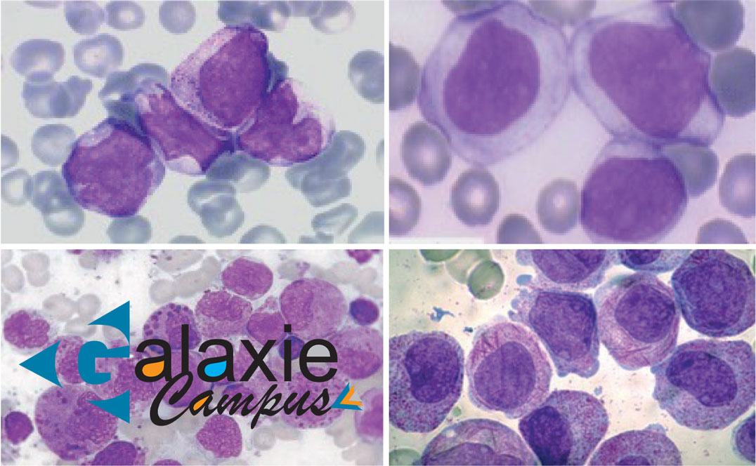 La cytométrie en flus dans les Leucémies Aigues