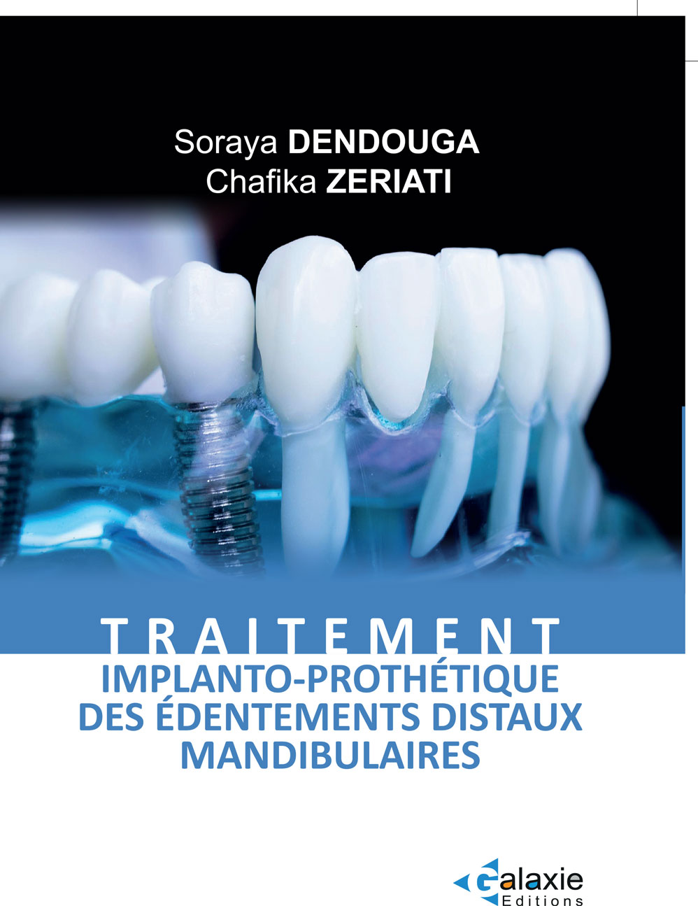 Traitement Implanto-Prothétique des édentements distaux mandibulaires