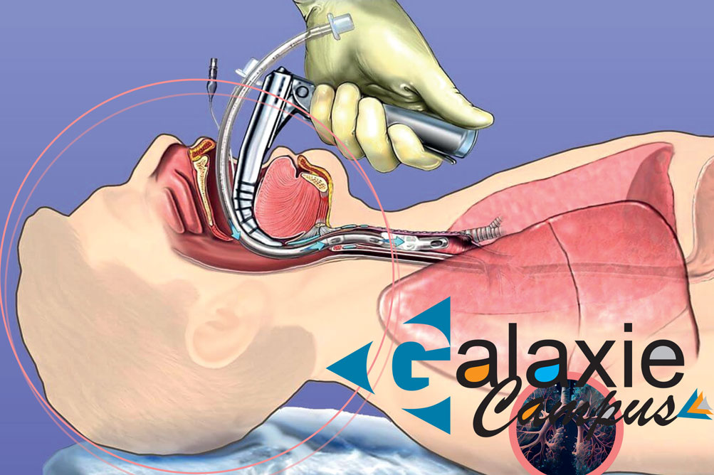 La Pratique Professionnelle de l'INTUBATION TRACHÉALE