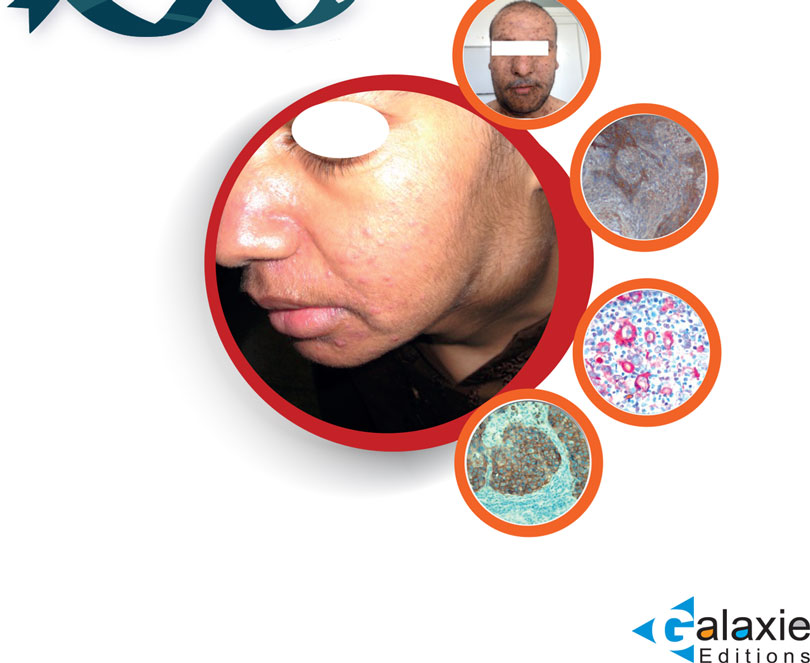 Surexpression du Récepteur de Facteur de Croissance Épidermique dans les CANCERS INDIFFÉRENCIÉS DU CAVUM