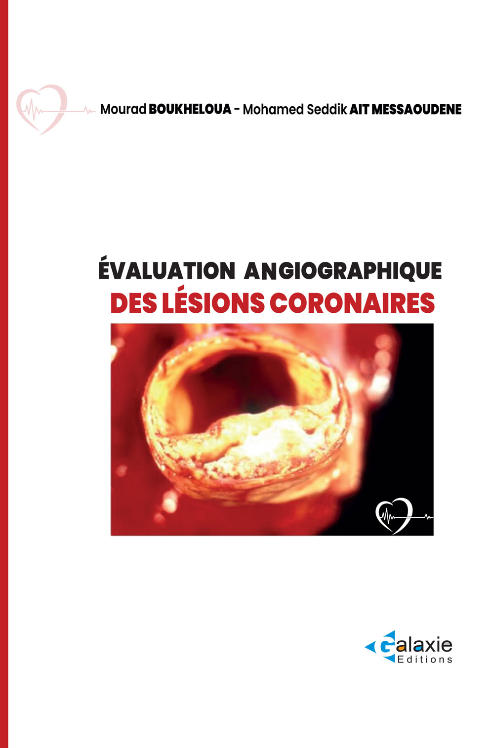 Évaluation Angiographique des LÉSIONS CORONAIRES