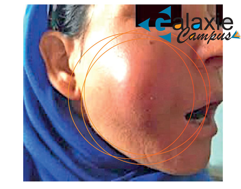 Médiastinites d'origine dentaire et ORL