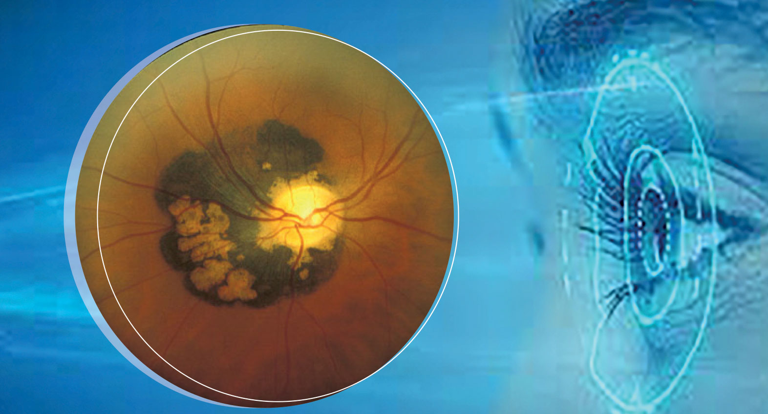 prise en charge des MELANOMES DE LA CHOROÏDE au CHU Mustapha