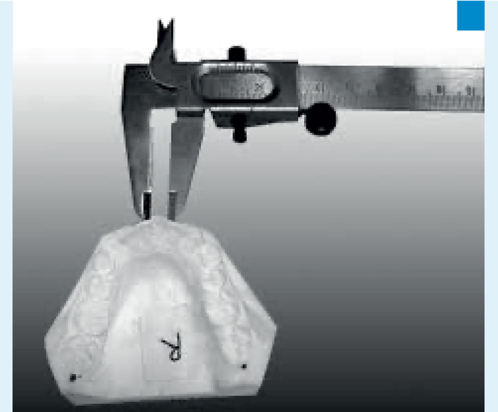 La Dysharmonie dento-maxillaire et son traitement en ORTHODONTIE