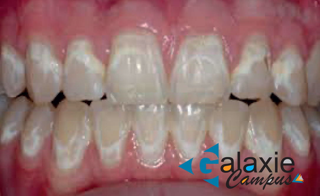 Les Déminéralisations AMÉLAIRES en Orthodentie