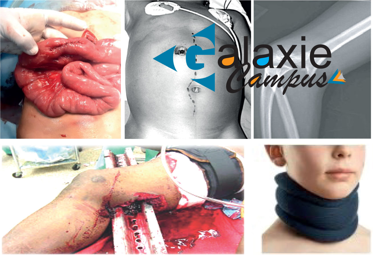 Les Traumatismes thoraco-abdominaux et périnéaux de l'ENFANT