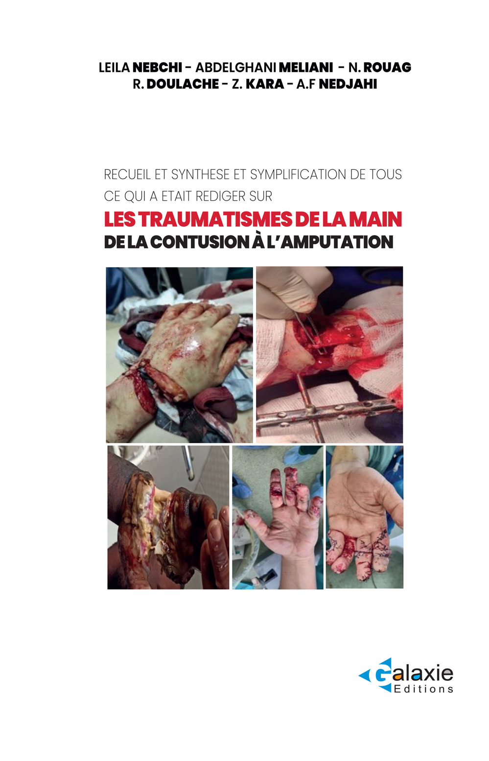 les traumatismes de la Main de la Contusion à l'Amputation