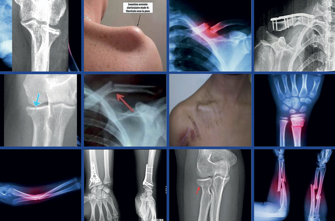 le livret des URGENCES DE TRAUMATOLOGIE de l'appareil Locomoteur Membre Supérieur pour les étudiants de la 7ème année