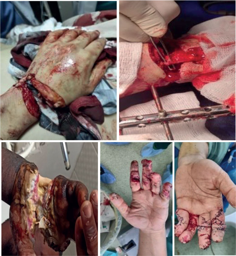 les traumatismes de la Main de la Contusion à l'Amputation