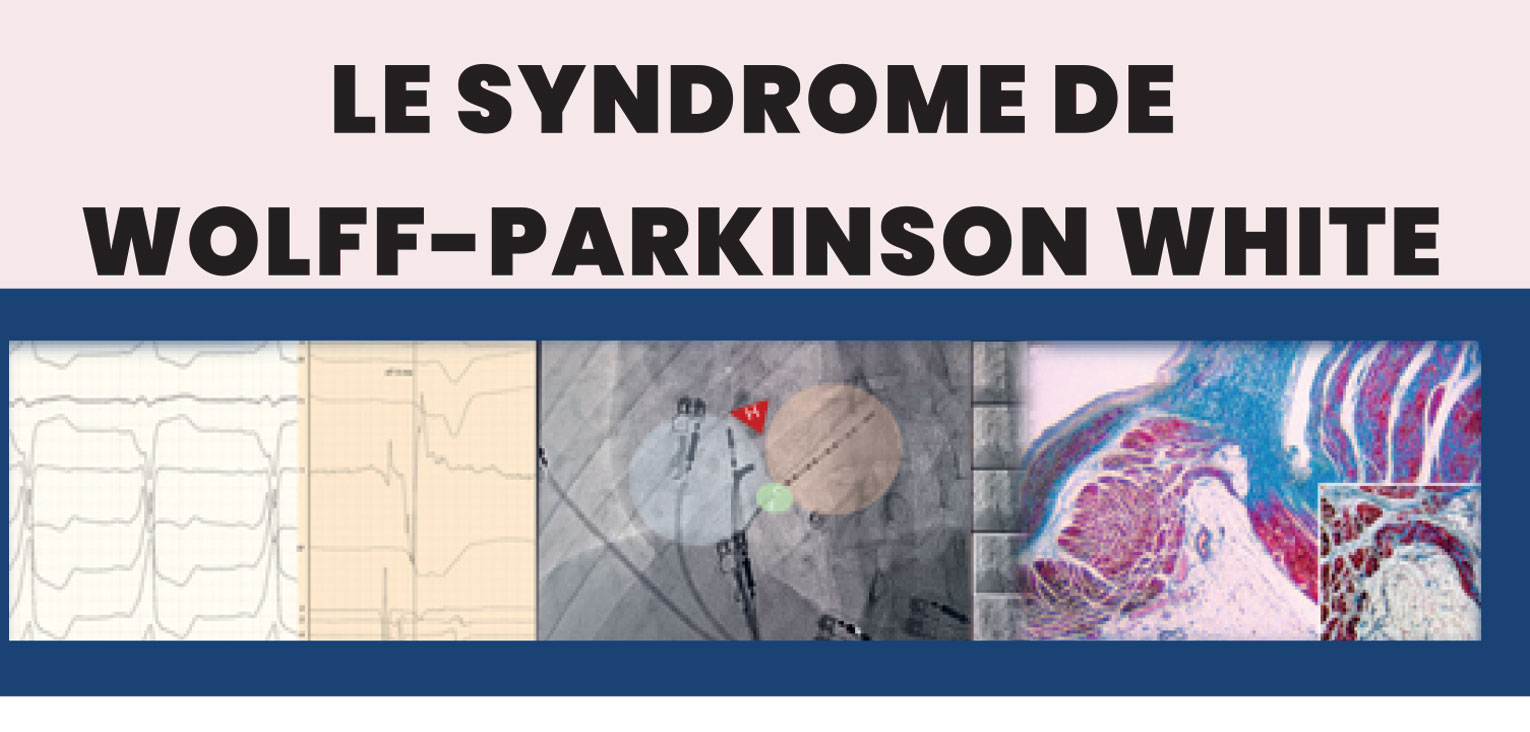 le Syndrôme de Wolff-Parkinson-White