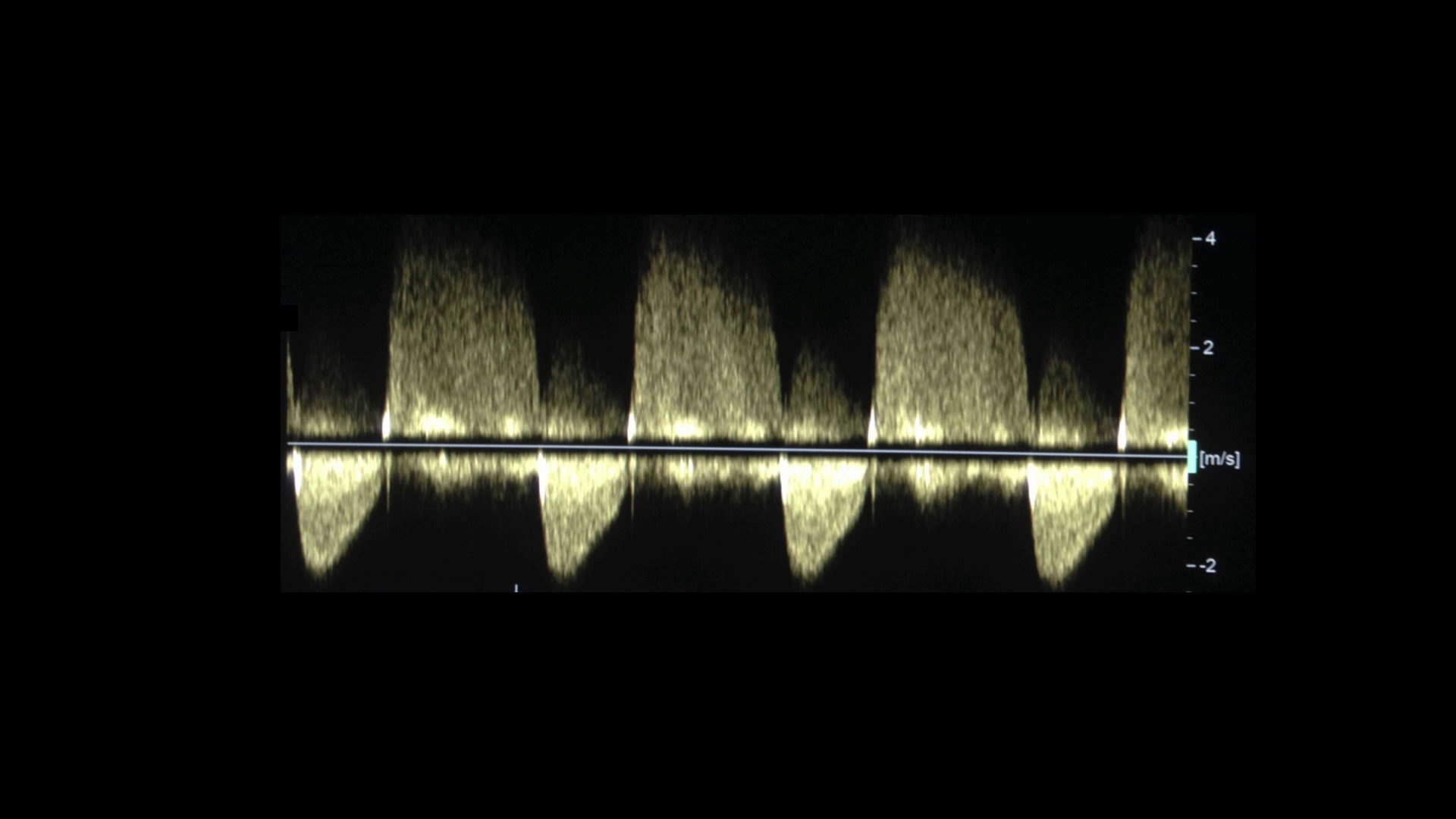 The Valves in Ultrasound