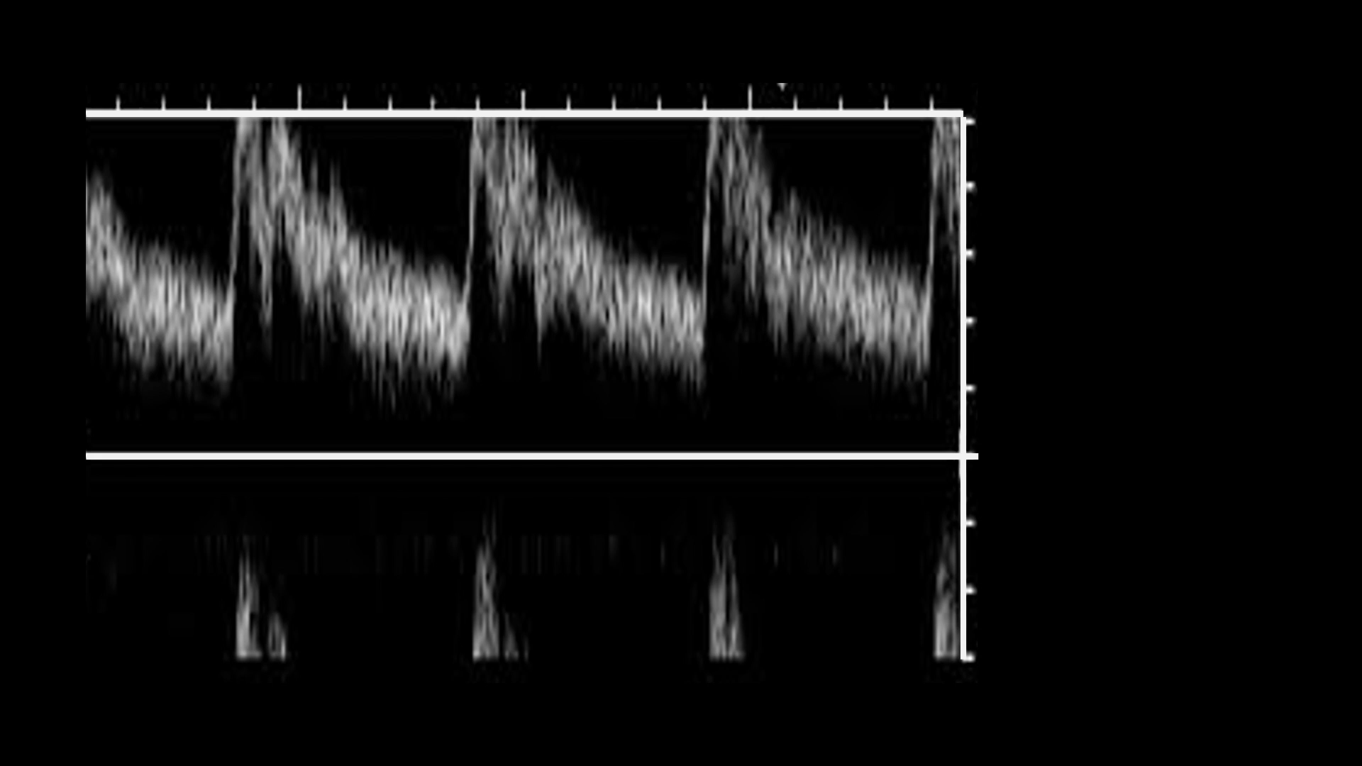 The Carotid Artery in Ultrasound