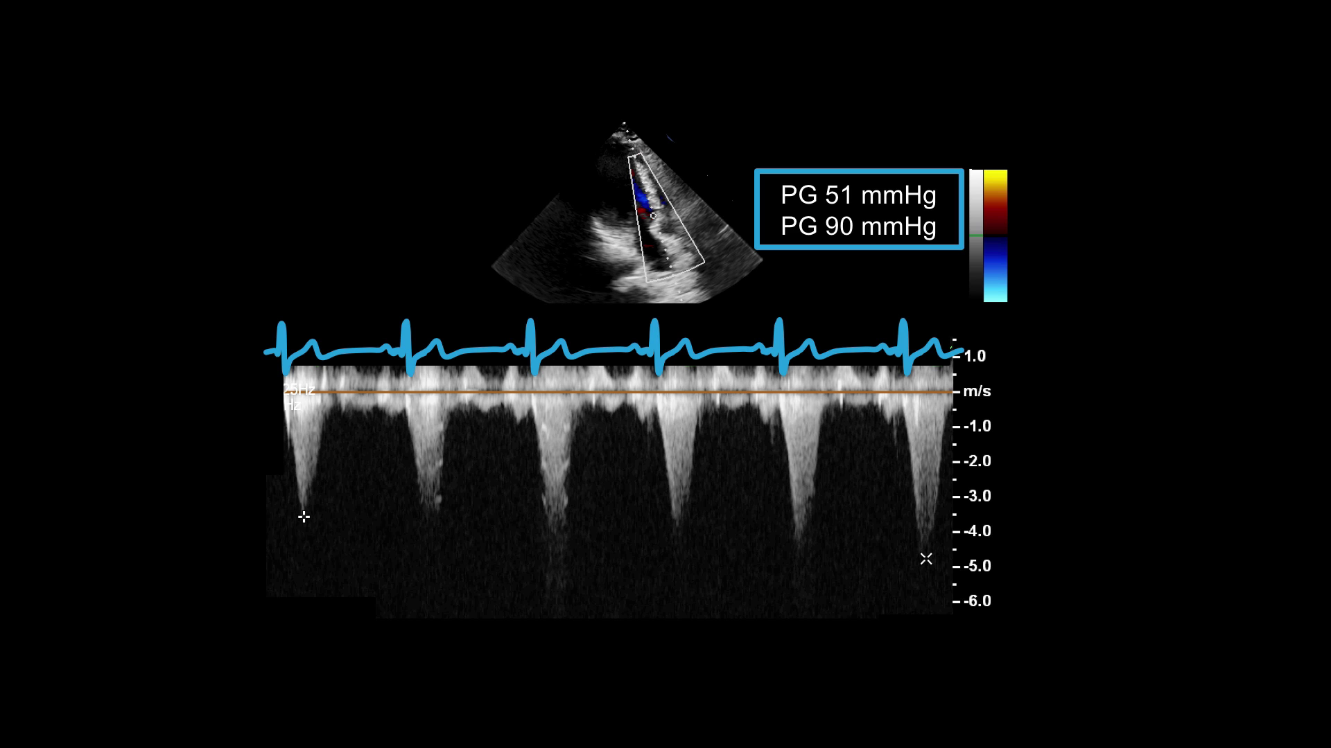 Adult Congenital Heart Disease in UltraSound